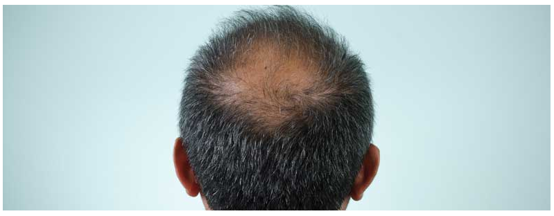 ​Embarrassing Problems: Hair loss