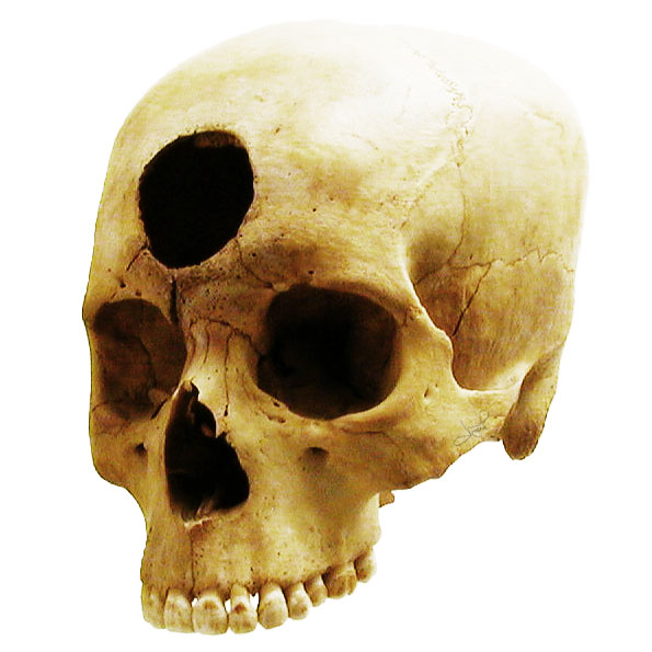 trepanned skull